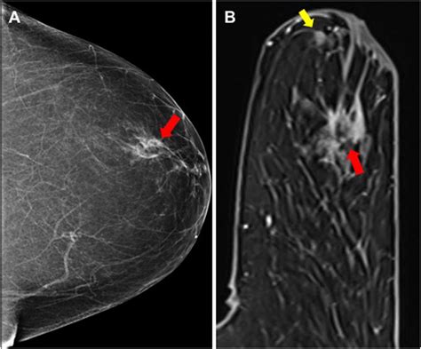 Preoperative Breast MR Imaging In Newly Diagnosed Breast Cancer