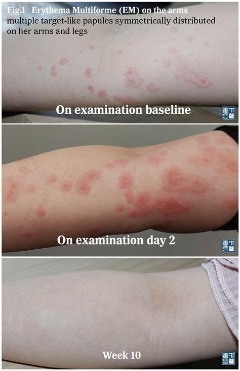 Erythema Multiforme Or Urticaria Vasculitis Different Paths Lead To The Same Destination 殊途同归