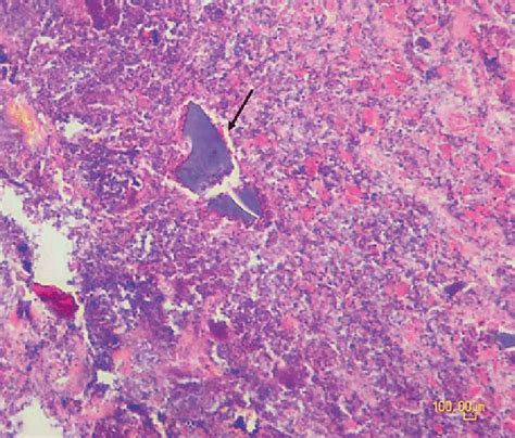 Histological Image Of The Necroinflammatory And Granulation Tissue Download Scientific Diagram