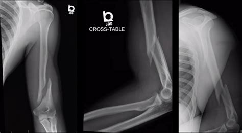 Distal Humerus ORIF