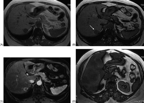 Imaging Of Hepatic Steatosis And Fatty Sparing European Journal Of