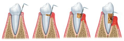 Periodontal Pocket Curettage And Debridement Dentist Belgrade