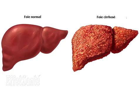 Cirrhose Hépatique Remèdes Maison