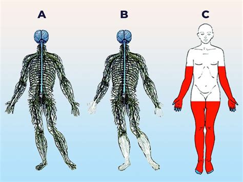 Polineuropatia Do Doente Crítico - Polineuropatia Do Doente Crítico - BRAINCP