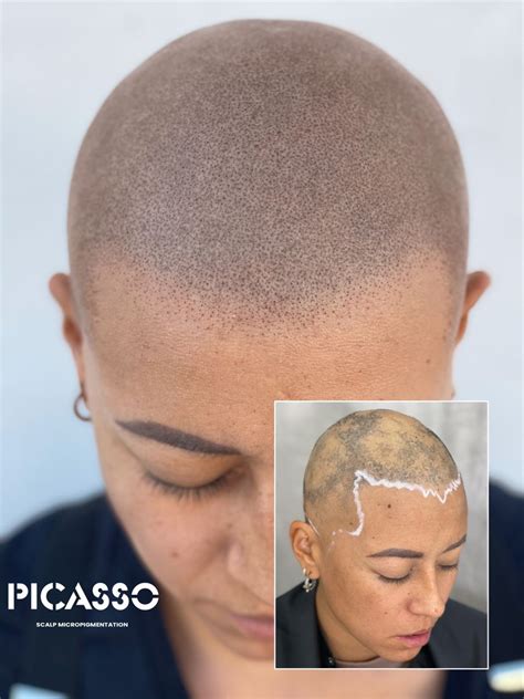 How To Stop Alopecia Areata From Spreading This Non Invasive Solution