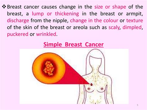 Breast Cancer Biomarkers Ppt