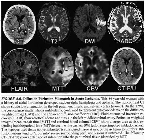 Stroke Symptoms Mri Terrible