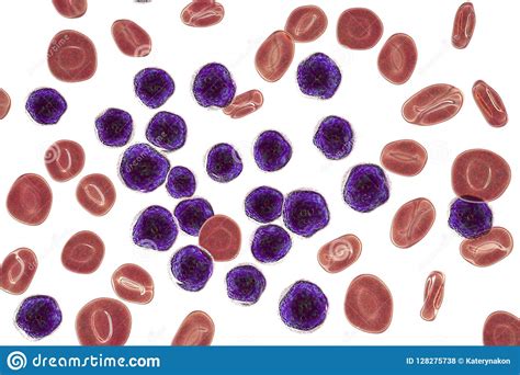 Leucemia Linfoblástica Aguda Mancha De La Médula Stock de ilustración