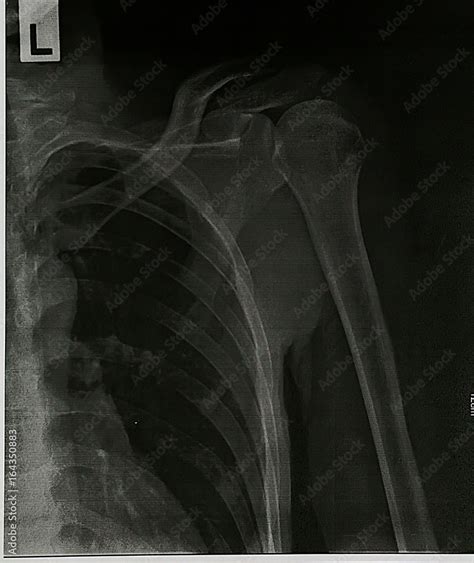 X-Ray Image of Human Chest for a medical diagnosis.Chest and lungs Xray ...