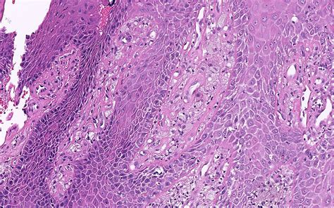 What Is The Diagnosis And What Are Common Locations For This Lesion