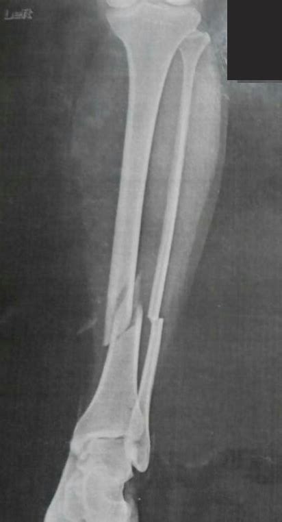 Tibial Shaft Fracture Hot Sex Picture