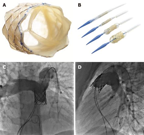 Melody Transcatheter Pulmonic Valve A En Face View Of Melody