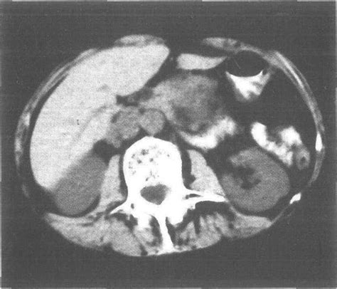 5 2 胰腺囊腺癌 CT诊断 医学