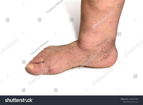 Swelling Female Leg Inflammation Diabetic Nephropathy Stock Photo ...