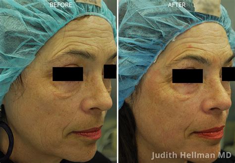 Co2 Laser Resurfacing Nyc Ultrapulse New York Skin Resurface