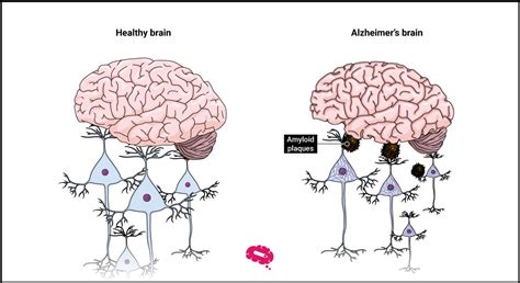 What Is Lecanemab The New Treatment For Alzheimers