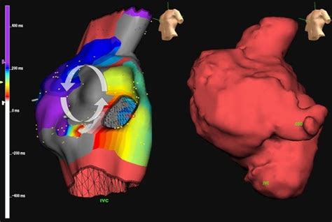 Electroanatomic Mapping In A Right Atrium To Pulmonary Artery Fontan