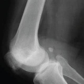 Radiographic Imaging Of The Right Knee In Anteroposterior A Lateral