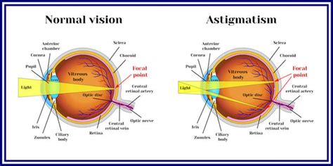 Understanding What Level Of Astigmatism Requires Glasses