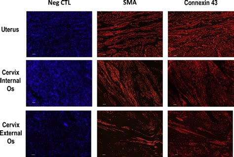 A New Paradigm For The Role Of Smooth Muscle Cells In The Human Cervix