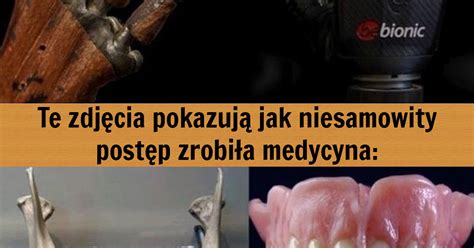 Kilka zdjęć które pokazują niesamowity postęp jaki zrobiła medycyna