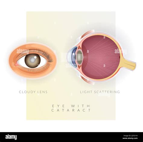 Human Eye With Cataract Cloudy Lens Illustration As Eps File