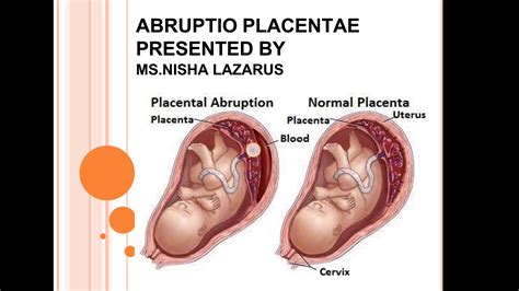 Abruptio Placenta Ppt YouTube