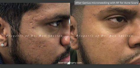 Microneedling With Rf Before And After Photos Ron Shelton Md