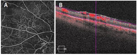 Using OCT Angiography To Diagnose High Risk Diabetic Retinopathy