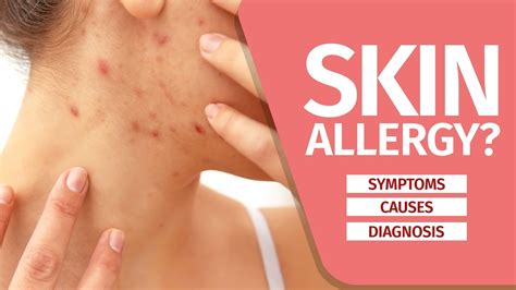 What Is Skin Allergy Symptoms Causes Diagnosis And Triggers Youtube