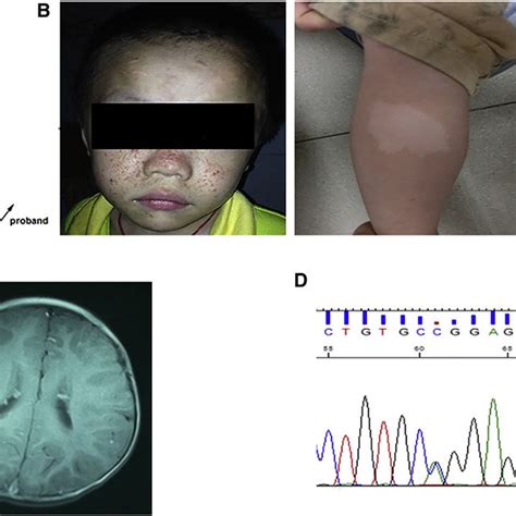 Clinical Characteristics Of The Patient With Tuberous Sclerosis Complex