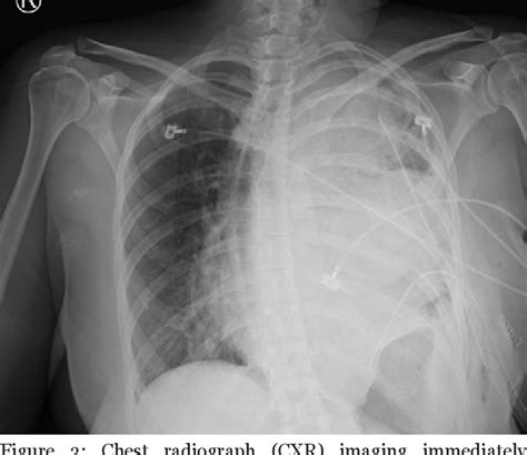 Figure From Surgical Considerations For Tension Hydrothorax In