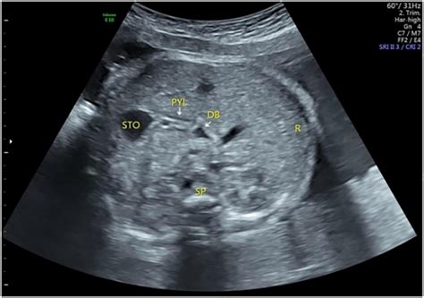 Frontiers Ultrasound Examination Of The Normal Fetal Duodenum