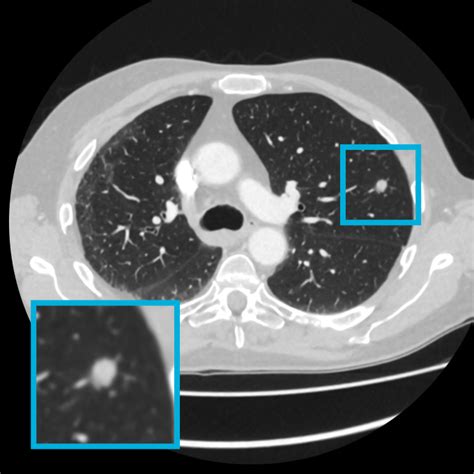 Lung nodule detection for routine clinical CT scans - Grand Challenge