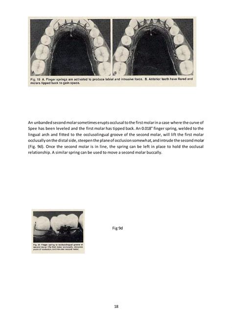 Transpalatal Nance Lingual Arch Quadhelix Appliances For