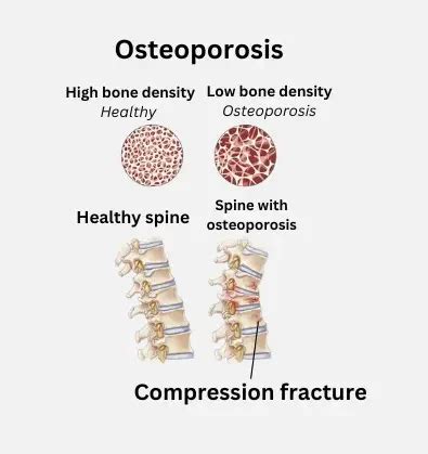 Osteoporotic Fractures | SpineDRX