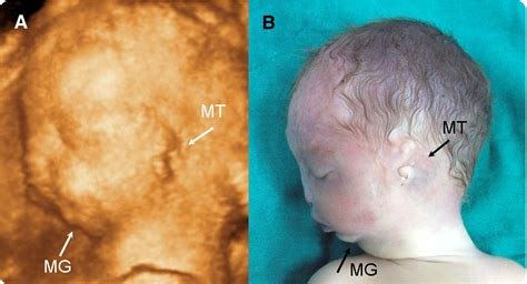 Sonographic Diagnosis Of Fetal Malformations Associated With