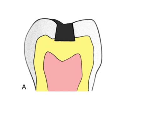 Dental Amalgam Flashcards Quizlet