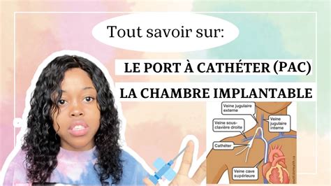 Tout Savoir Sur Le Port Catheter Pac La Chambre Implantable Pac