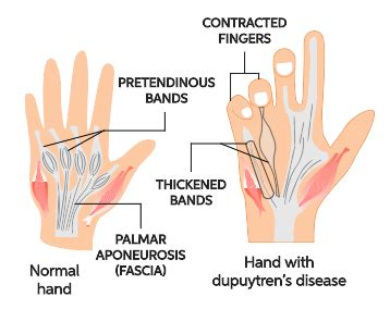 What Causes Muscle Contractures