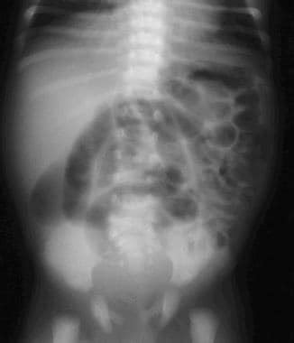 MECONIUM ILEUS VS MECONIUM PLUG SYNDROME Radiologi Id 11607 | Hot Sex ...