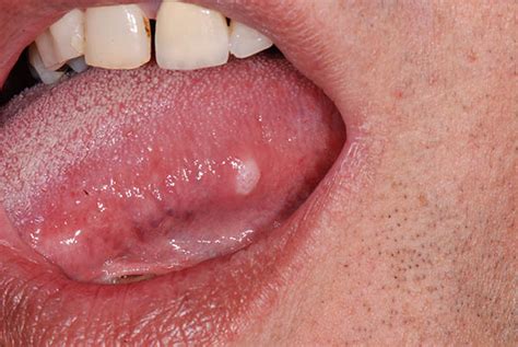 Oral Cancer Symptoms Treatment And Stages