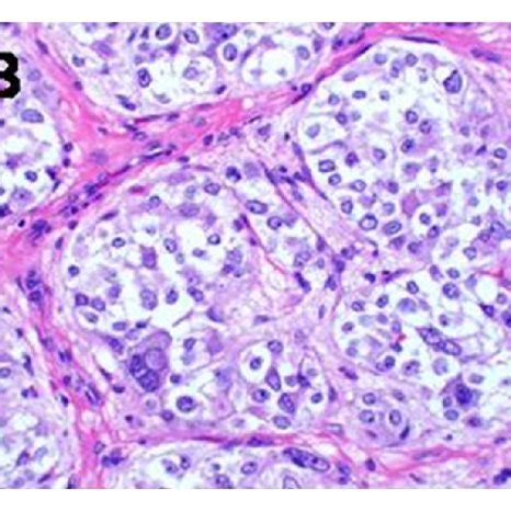 Clinical Features of MEN2B syndrome. Note (a) the laxity in the first ...