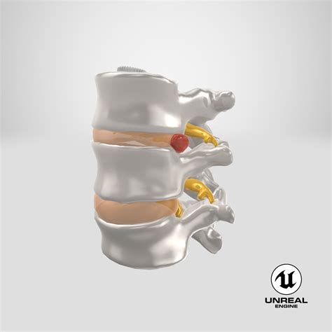 Spinal Vertebrae with Hernia 3D Model $49 - .gltf .obj .ma .max .upk