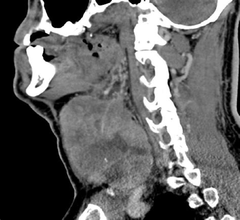 Anaplastic Thyroid Cancer Neuro Mr Case Studies Ctisus Ct Scanning