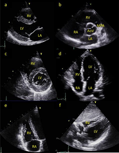 Echocardiographic Assessment Of The Right Ventricle State Of The Art