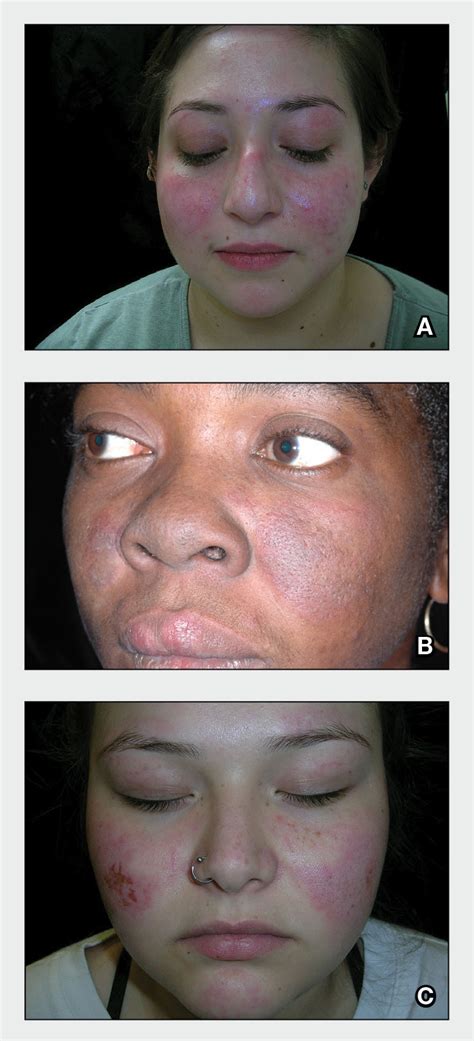 Subacute Cutaneous Lupus In African Americans