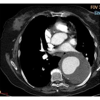 Fusiform Ascending Aortic Aneurysmsagittal Reconstructed CT Image In A