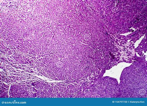 Hepatocellular Carcinoma Light Micrograph Stock Photo Image Of