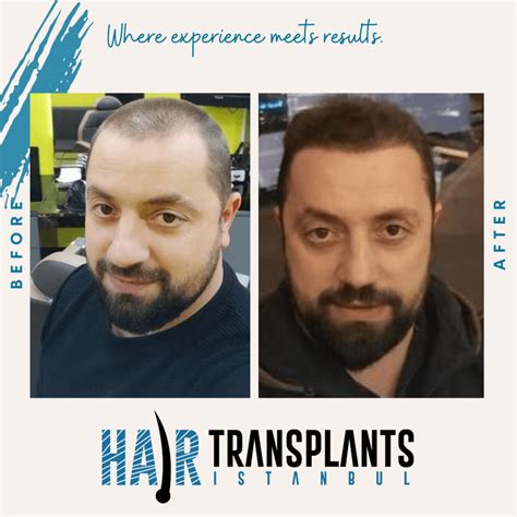 DHI Hair Transplant Clinic in Istanbul, Turkey | DHI Cost | Hair ...